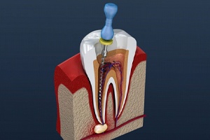 illustration of a root canal procedure